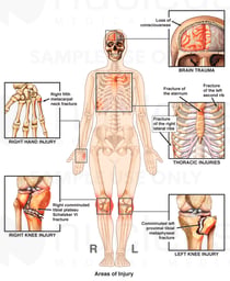 Female Skeletal Figure with Brain Injury, and Fractures of the Hand, Sternum, Ribs and Knees Bilaterally