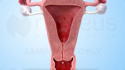 Birth Control Shot (Medroxyprogesterone Injection)