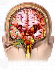 Coronal Ear and Brain Anatomy with Spread of Bacterial Meningitis