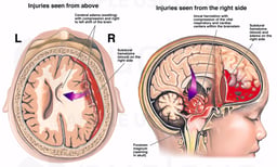 Child Brain Injury - Subdural Hematoma, Uncal Brainstem Herniation and Death