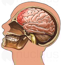 Brain with Whiplash Injury, Lateral View
