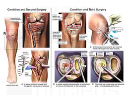 Subsequent Conditions with Second and Third Surgeries