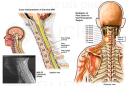 Cervical Spine Injury