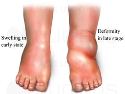 Diabetic Feet