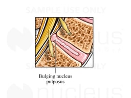 Intervertebral Disc Anatomy