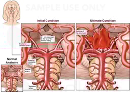 Aneurysm at Circle of Willis