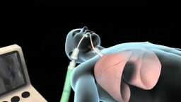 Intubation and Mechanical Ventilation