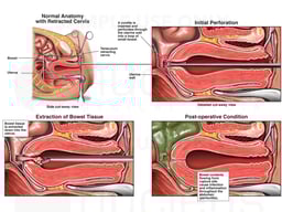 Intra-operative Uterine Perforation with Small Bowel Injury and Subsequent Complications