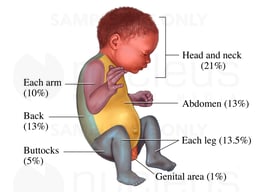Rule of Nines for a Baby
