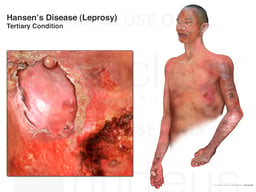 Hansen's Disease: Leprosy Tertiary Condition