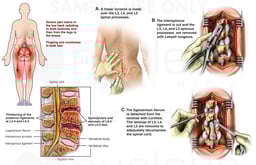 Lumbar Spinal Stenosis with Subsequent Laminectomy