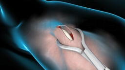 Vasectomy