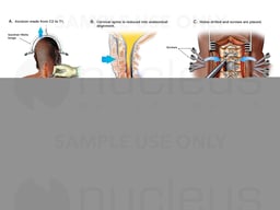 Open Reduction of Cervical Fracture Dislocation with Posterior Spinal Fusion