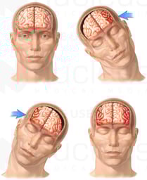 Whiplash - Side to Side Closed Head Injury