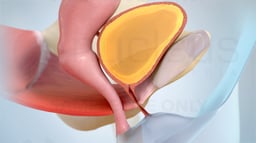 Understanding Stress Urinary Incontinence (SUI)