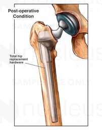 Total Hip Replacement
