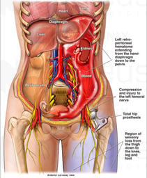 Retroperitoneal Hematoma with Femoral Nerve Damage