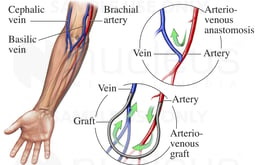 Arteriovenous Access