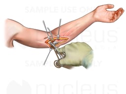 Impingement of Ulnar Nerve