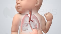 Tracheoesophageal Fistula Repair (Pediatric)
