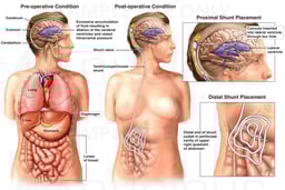 Hydrocephalus and Ventriculoperitoneal (VP) Shunt