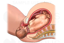 Birth Injury - Shoulder Dystocia with Right Brachial Plexus Injury Caused by Pubic Symphysis