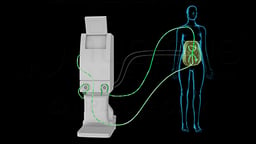 Heated Intraperitoneal Chemotherapy (HIPEC)