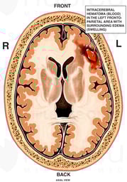 Post-accident Head and Brain Injuries