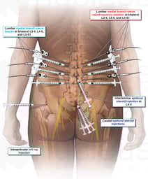 Injections and Radiofrequency Ablation Procedures