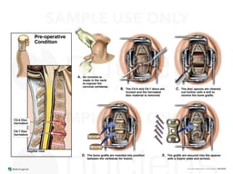 Cervical Spine Injuries and Fusion Surgery