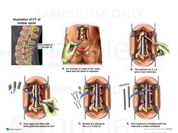 Lumbar Spine Injuries with Double Level Posterior Laminectomy and Fusion
