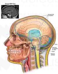 Brainstem Tumor with Obstruction of Cerebrospinal Fluid (CSF) Flow through the 4th Ventricle