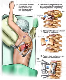 Proposed Thoracotomy with Antero-Lateral Thoracic Spinal Fusion