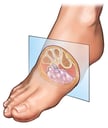 Plantar Neuroma: Cross section of the Foot
