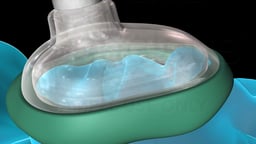 Close-Up of Anesthesia Delivery Via Face Mask