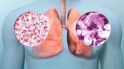 Understanding Lung Cancer