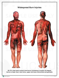 Burn Injuries to tbe Head, Upper Extremities, Chest Back and Thighs,