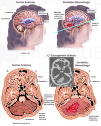 Intracranial Hemorrhage