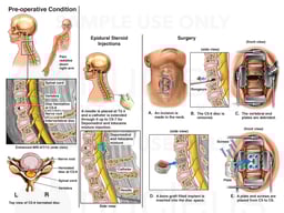 Cervical Disc Injuries with Pain Management Procedures and Scheduled DIscectomy/Fusion Surgery
