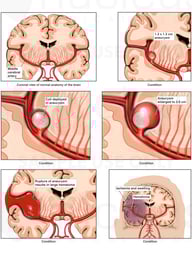 Progression of Cerebral Aneurysm