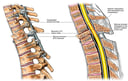 Surgical Fusion and Spinal Cord Injury