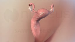 Intrauterine Device (IUD)