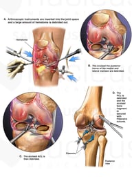 Arthroscopic Repair of PCL, Proximal Tibia and Menisci