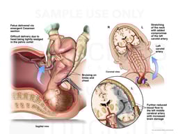 Cesarean Delivery with Further Compromise of the Vessels in the Neck