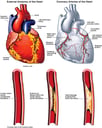 Anatomy of the Heart with Potential Blockage Sites in Coronary Arteries