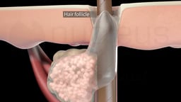 Hair Follicle (Labeled) with Sebaceous Gland