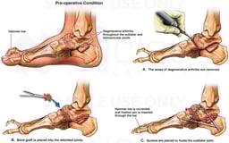 Development of Subtalar Arthritis with Eventual Surgical Fusion