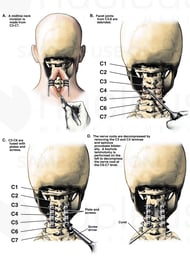 C3-C4 Posterior Cervical Laminectomies, C6-7 Laminotomy and Spinal Fusion Surgery