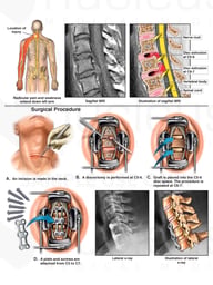 Cervical Spine Injury with Double Level Anterior Discectomy and Fusion Procedure
