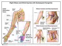 Right Elbow and Wrist Injuries with Subsequent Surgeries